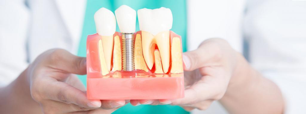 woman dentist take implant tooth
