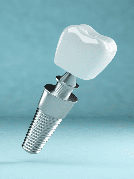 dental implant nursing