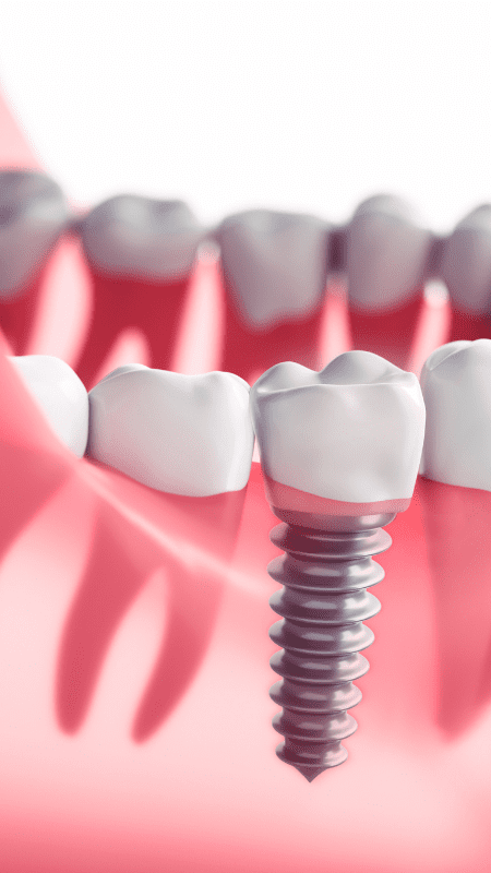 dental implant nursing