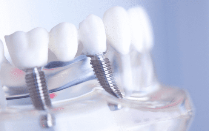 dental implant nursing