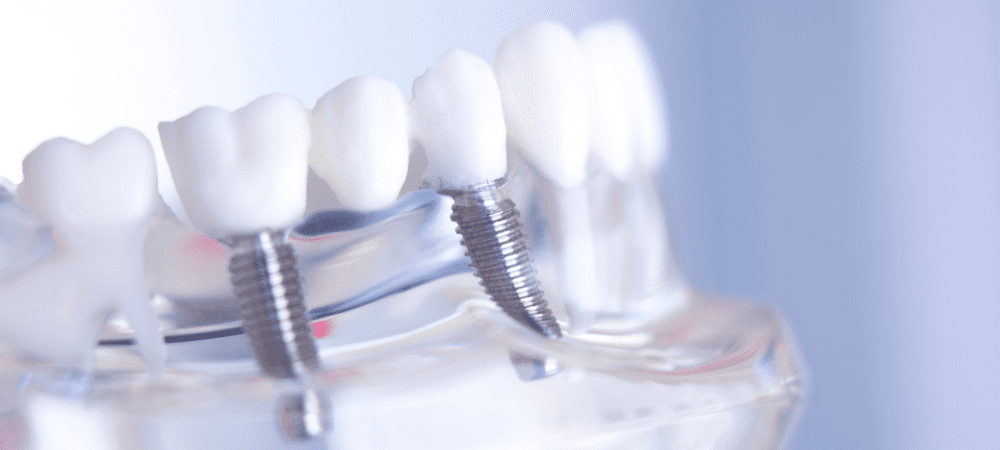 dental implant nursing