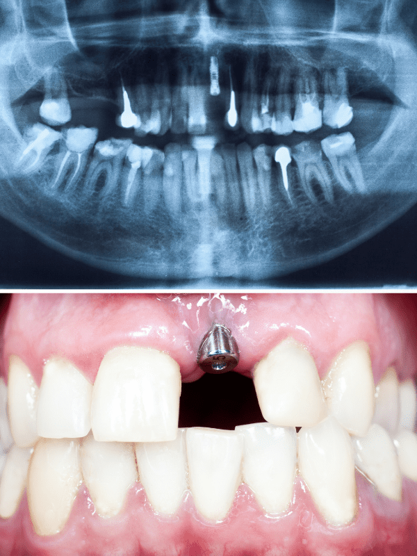 NEBDN certificate in dental implant Nursing