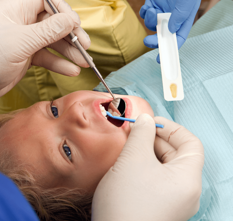 Fluoride Varnish Application